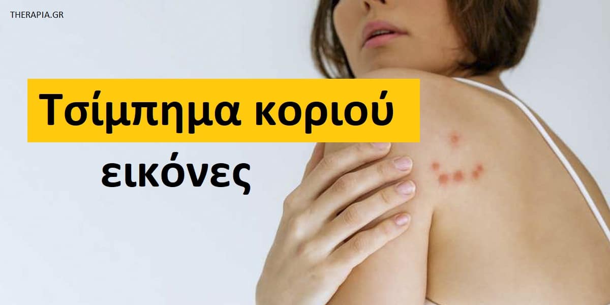 Τσίμπημα κοριού εικόνες, Τσίμπημα κοριού, Εικόνες από τσίμπημα κοριού, Συμπτώματα από τσίμπημα κοριού, Θεραπεία τσιμπήματος από κοριό, Αντιμετώπιση τσιμπήματος από κοριό