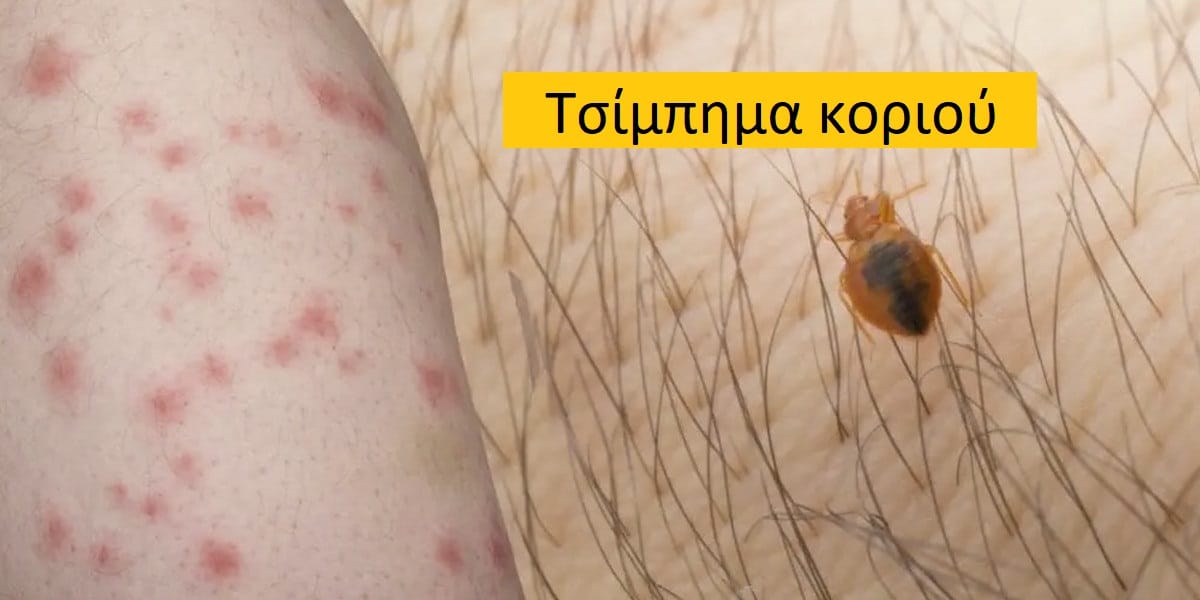 Τσίμπημα κοριού εικόνες, Τσίμπημα κοριού φωτογραφίες, Τσίμπημα κοριού