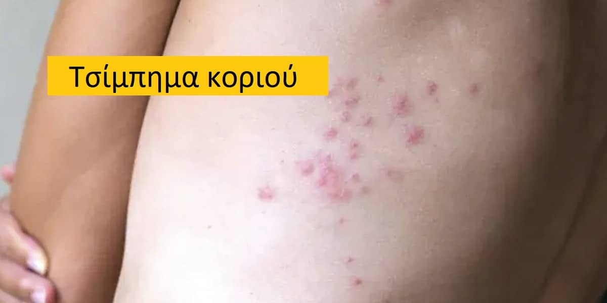 Τσίμπημα κοριού, Εικόνες από τσίμπημα κοριού, φωτογραφίες από τσίμπημα κοριού