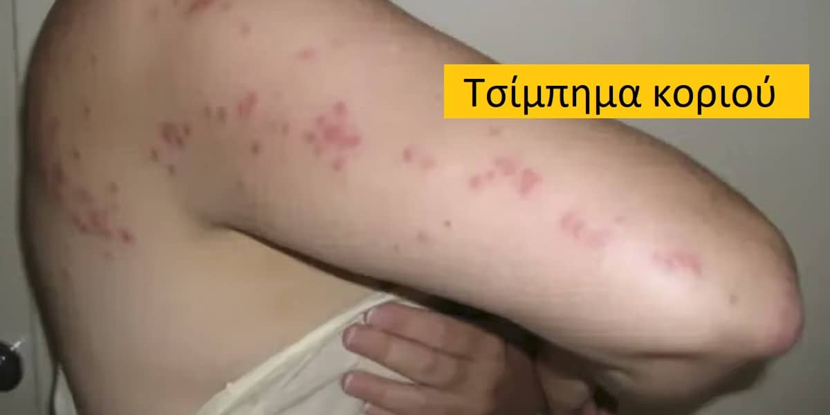 Τσίμπημα κοριού, τσίμπημα κοριού εικόνες, Κοριός