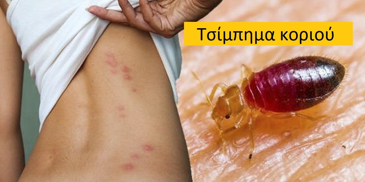 Τσίμπημα κοριού εικόνες, Τσίμπημα κοριού φωτογραφίες, Τσίμπημα κοριού