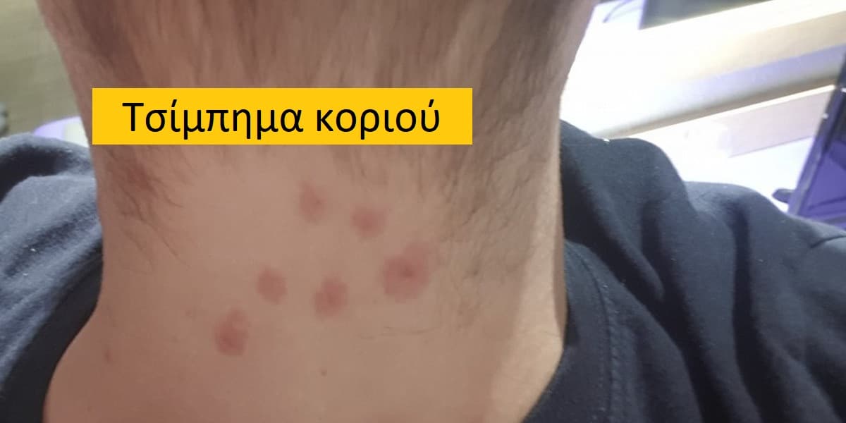 Τσίμπημα κοριού, Τσίμπημα κοριού εικόνες, Τσίμπημα κοριού συμπτώματα