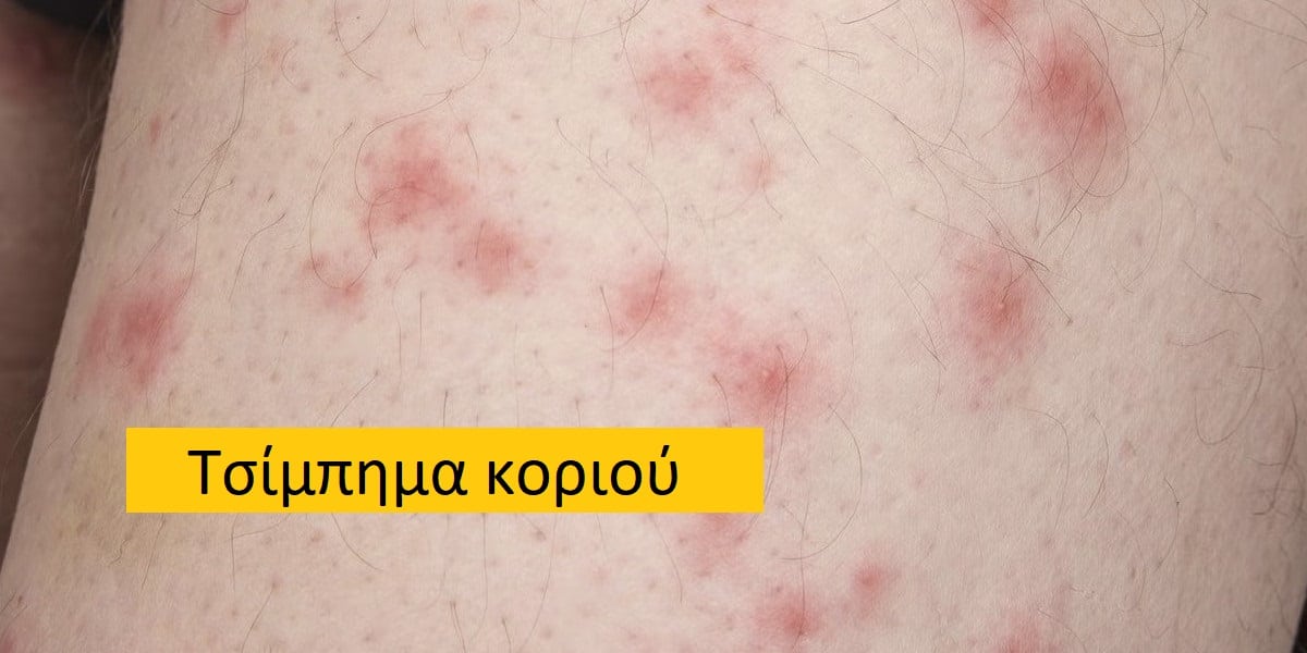 Τσίμπημα κοριού εικόνες, Κοριός, Τσίμπημα κοριού