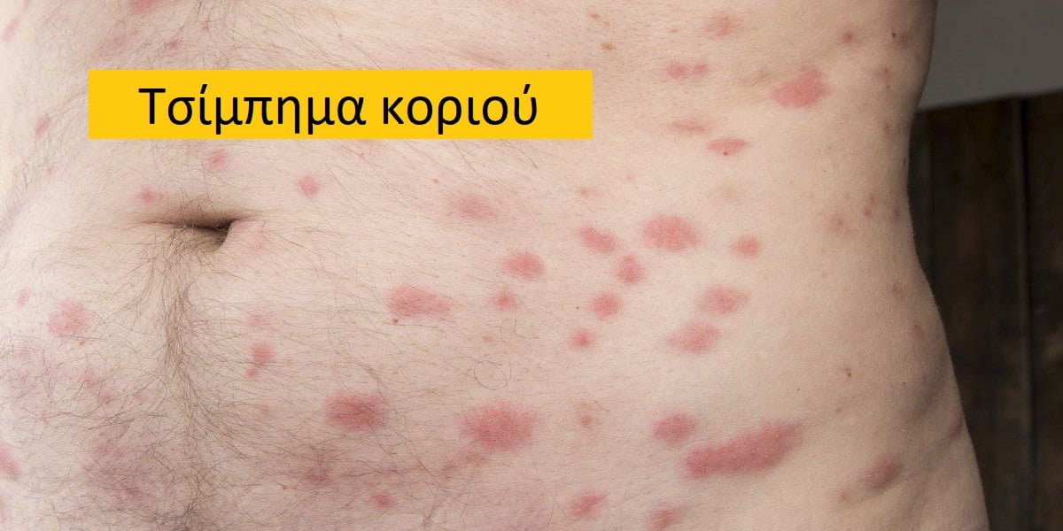 Τσίμπημα κοριού εικόνες, Κοριός, Τσίμπημα κοριού
