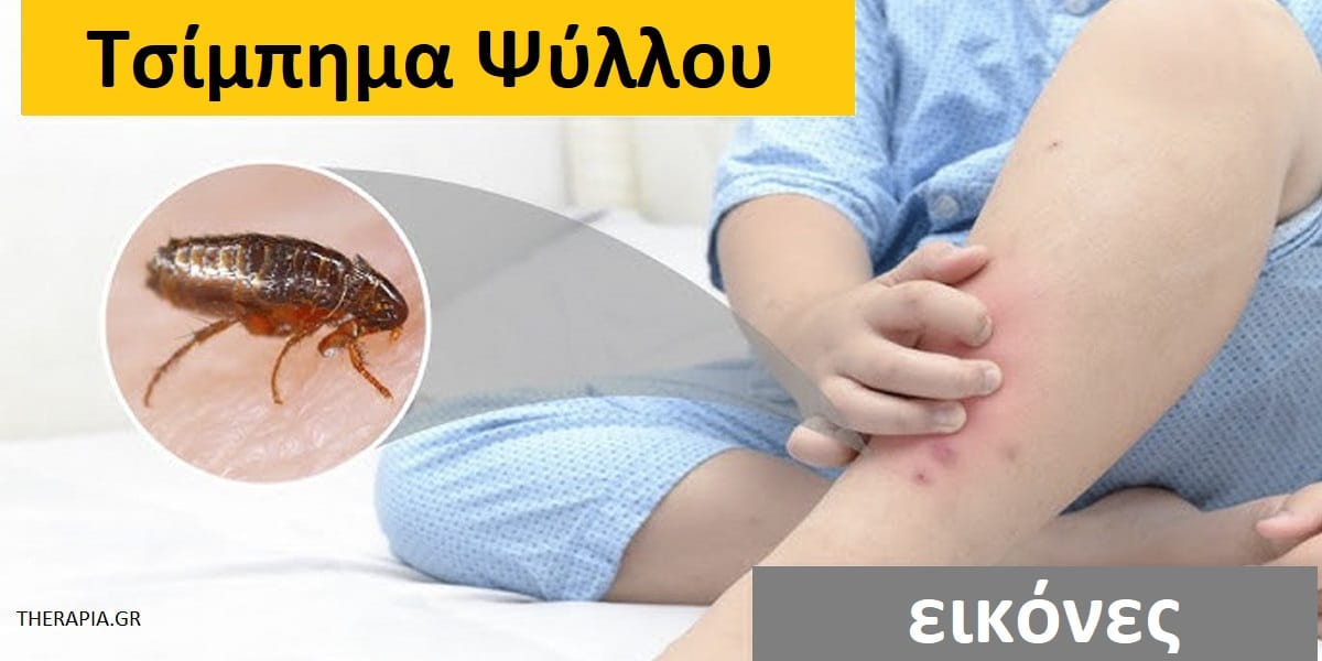 Τσίμπημα ψύλλου εικόνες, Τσίμπημα ψύλλου φωτογραφίες, Τσίμπημα ψύλλου, Πως μοιάζει το τσίμπημα από ψύλλο, Συμπτώματα από τσίμπημα ψύλλου, Θεραπεία για το τσίμπημα από ψύλλο, Ποιους τσιμπά ο ψύλλος, Ξενιστές ψύλλων, Πρόληψη τσιμπήματος από ψύλλο, Αντιμετώπιση τσιμπήματος από ψύλλο