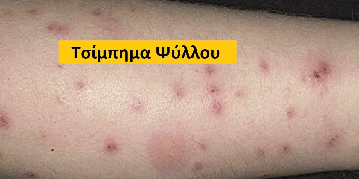 Τσίμπημα ψύλλου, Τσίμπημα ψύλλου εικόνες, Τσίμπημα ψύλλου φωτογραφίες