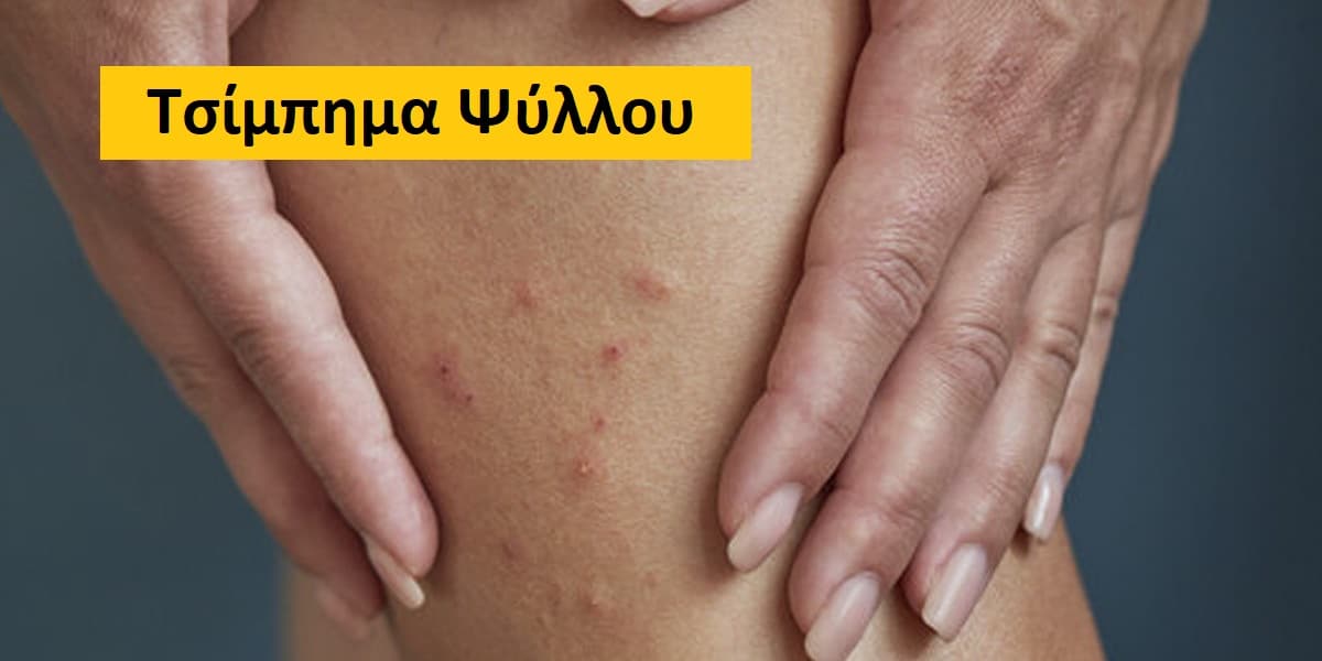 Τσίμπημα ψύλλου, Εικόνες από τσίμπημα ψύλλου, Φωτογραφίες από τσίμπημα ψύλλου