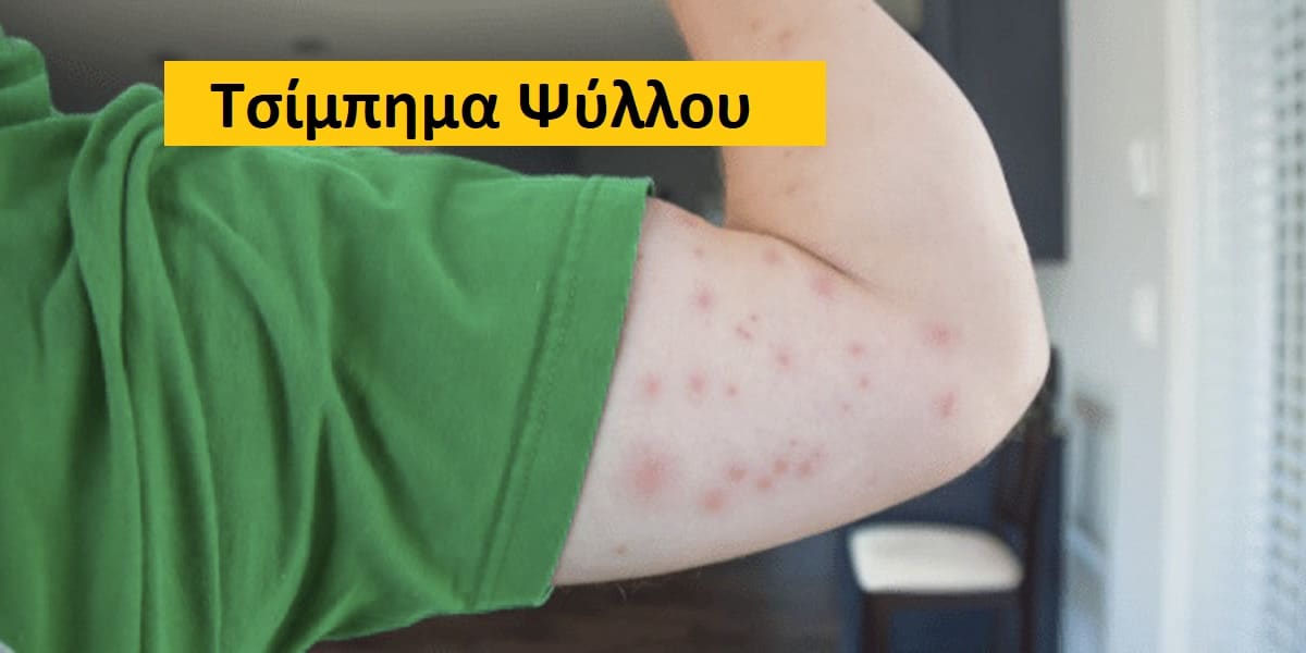 Τσίμπημα ψύλλου εικόνες, Τσίμπημα ψύλλου φωτογραφίες, Τσίμπημα ψύλλου