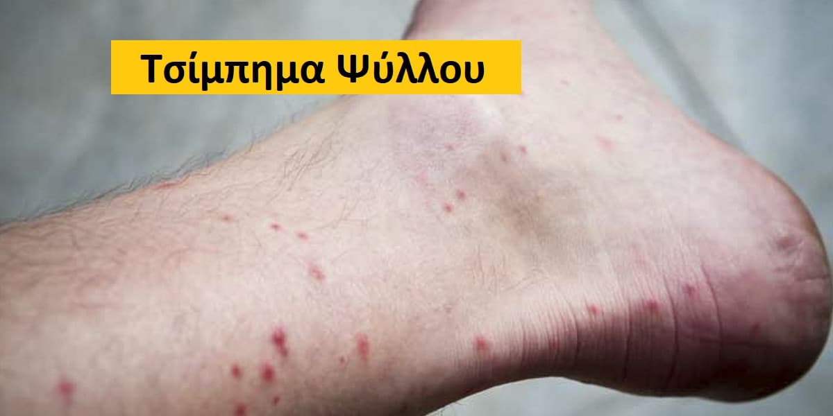 τσίμπημα ψύλλου εικόνες, Συμπτώματα από τσίμπημα ψύλλου, Θεραπεία τσιμπήματος ψύλλου