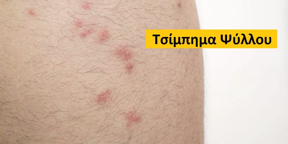 Τσίμπημα ψύλλου, Πως μοιάζει το τσίμπημα του ψύλλου, Τσίμπημα ψύλλου εικόνες