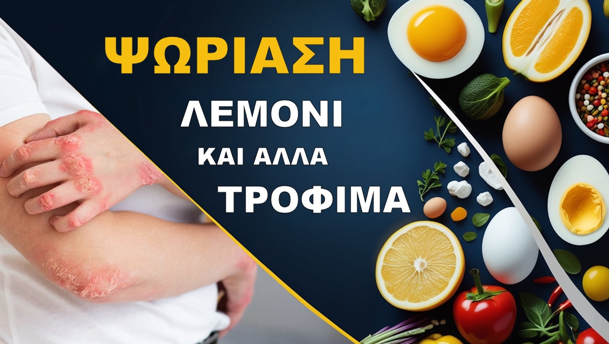 Ψωρίαση, Λεμόνι, Τρόφιμα, Αυγά, Ελιές, Σόδα, Λάδι