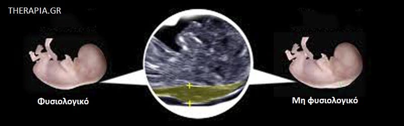 Αυχενική διαφάνεια, Εγκυμοσύνη, Εξετάσεις εγκυμοσύνης