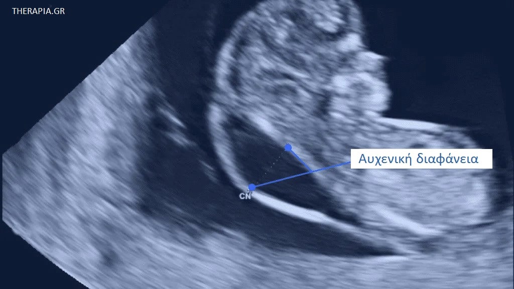 Αυχενική διαφάνεια, Εγκυμοσύνη, Εξετάσεις εγκυμοσύνης