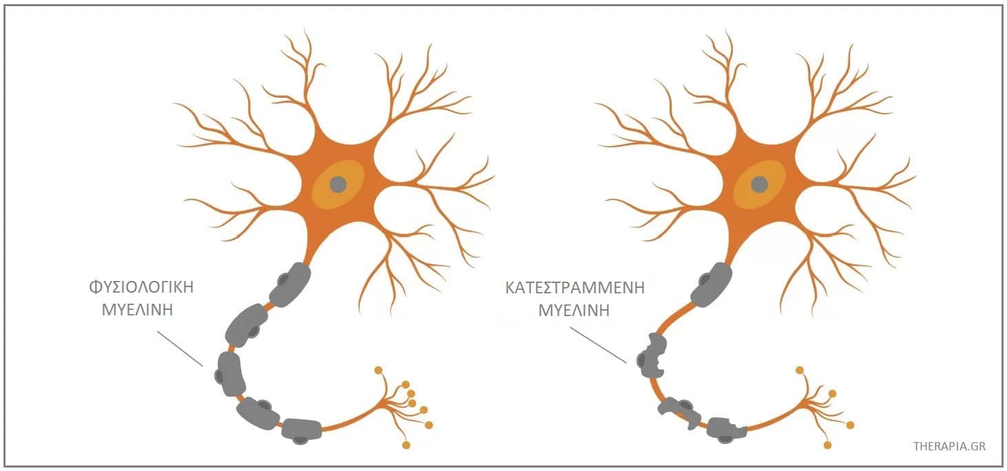 Σκλήρυνση κατά πλάκας, Σκλήρυνση κατά πλάκας συμπτώματα, Μυελίνη