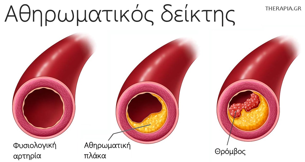 Αθηρωματικός δείκτης, Αγγείο, Χοληστερίνη, Αθηρωμάτωση, Θρόμβος