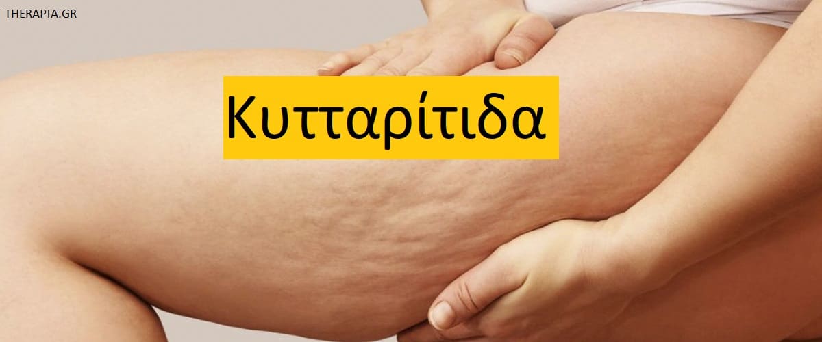 Κυτταρίτιδα, Αντιμετώπιση κυτταρίτιδας, Αισθητικές παρεμβάσεις για την κυτταρίτιδα, Προσεγγίσεις που συνιστώνται για την κυτταρίτιδα, Προσεγγίσεις που δεν συνιστώνται για την κυτταρίτιδα, Παρεμβάσεις στο σπίτι για την κυτταρίτιδα, Μείωση κυτταρίτιδας