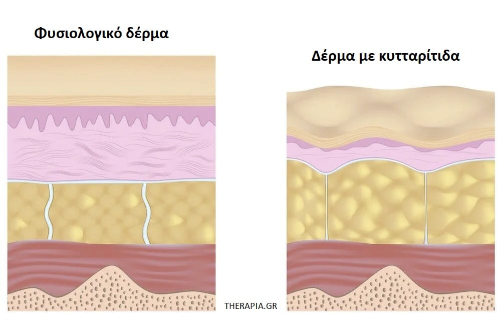 Κυτταρίτιδα, Μείωση κυτταρίτιδας, Παρεμβάσεις για την κυτταρίτιδα