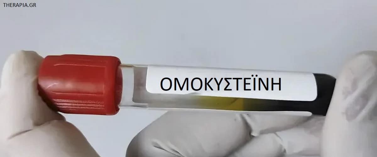 Ομοκυστεΐνη, Πότε γίνεται η εξέταση ομοκυστεΐνης, Φυσιολογικές τιμές ομοκυστεΐνης, Υψηλές τιμές ομοκυστεΐνης, Χαμηλές τιμές ομοκυστεΐνης, Φάρμακα που επηρεάζουν την εξέταση ομοκυστεΐνης