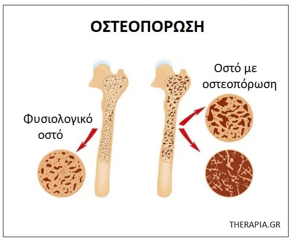 Οστεοπόρωση, Μέτρηση οστικής πυκνότητας, Διάγνωση οστεοπόρωσης