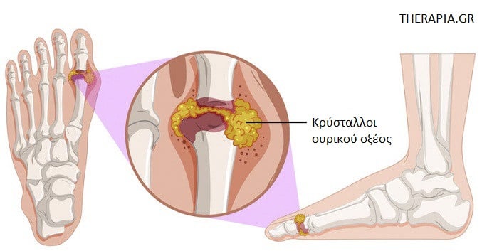 Ουρικό οξύ, Ουρική αρθρίτιδα, Εξαεταση ουρικού οξέος