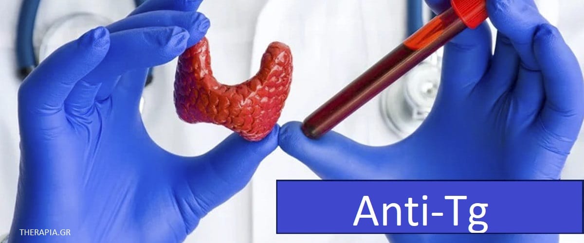Anti Tg, Θυρεοειδής, Υποθυρεοειδισμός, Εξετάσεις θυρεοειδή, Πότε γίνεται η εξέταση anti Tg, Φυσιολογικές τιμές anti TG, Υψηλές τιμές anti Tg, Χαμηλές τιμές anti Tg, Φάρμακα που επηρεάζουν την εξέταση anti Tg