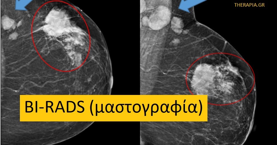 BI-RADS, Μαστογραφία, Όγκοι στο στήθος