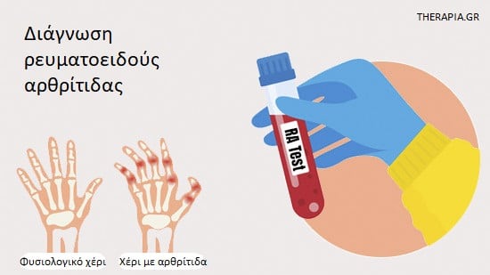RA test, Ρευματοειδής αρθρίτιδα, Αυτοάνοσα νοσήματα